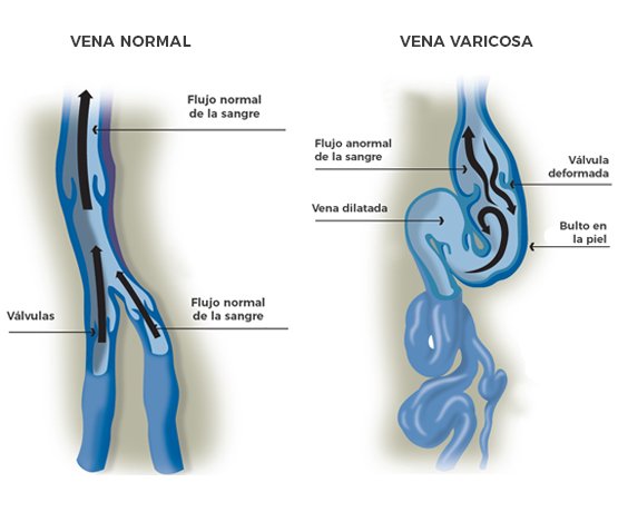 Tratamiento para varices