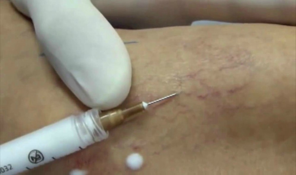 Escleroterapia con inyecciones(espuma o laser)