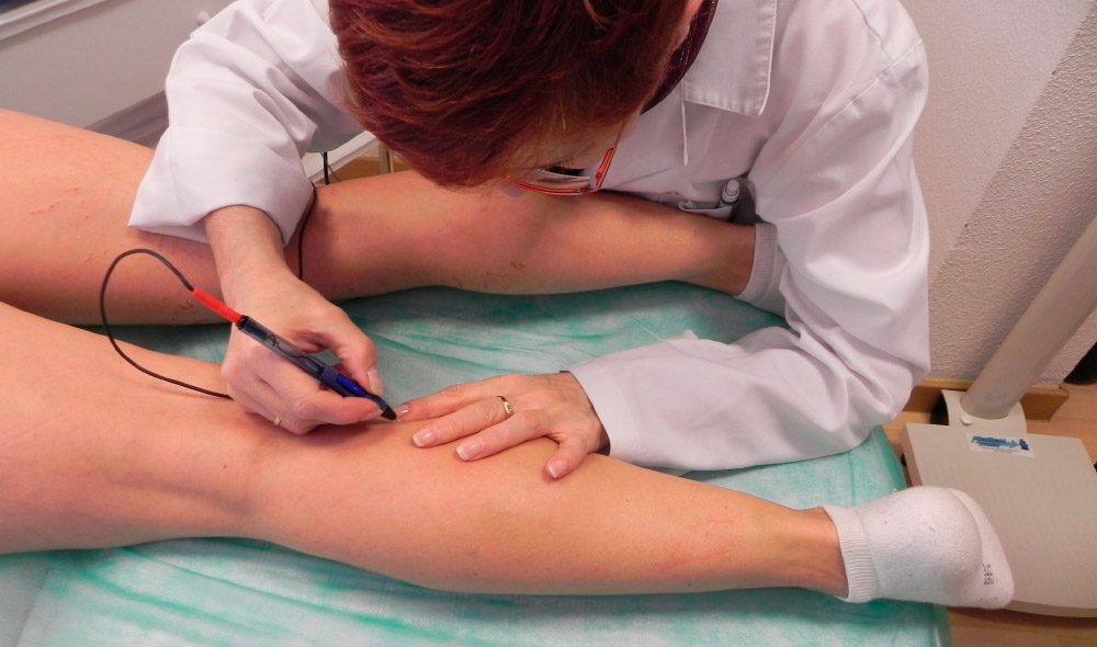 Tratamiento para varices